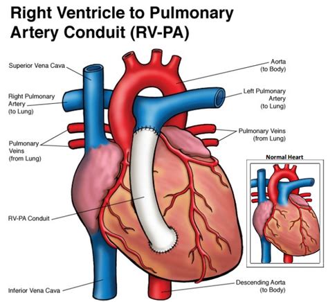 right ventricle pulmonary artery conduit.